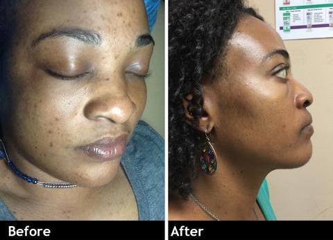 Glutathione Skin Lightening Suppositories