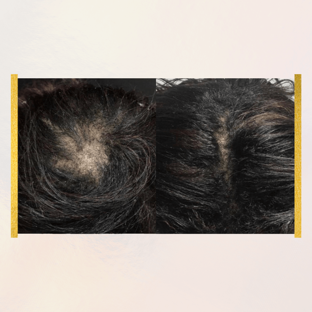 Thro-Grower Minoxidil 5% | Advanced Hair Regrowth
