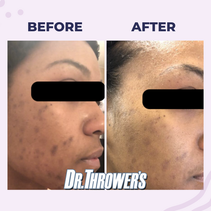 Acne & Dark Spot Removal Kit