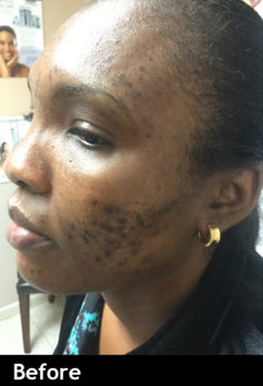 Hydrotret Cream | Blackhead/Whitehead Eraser