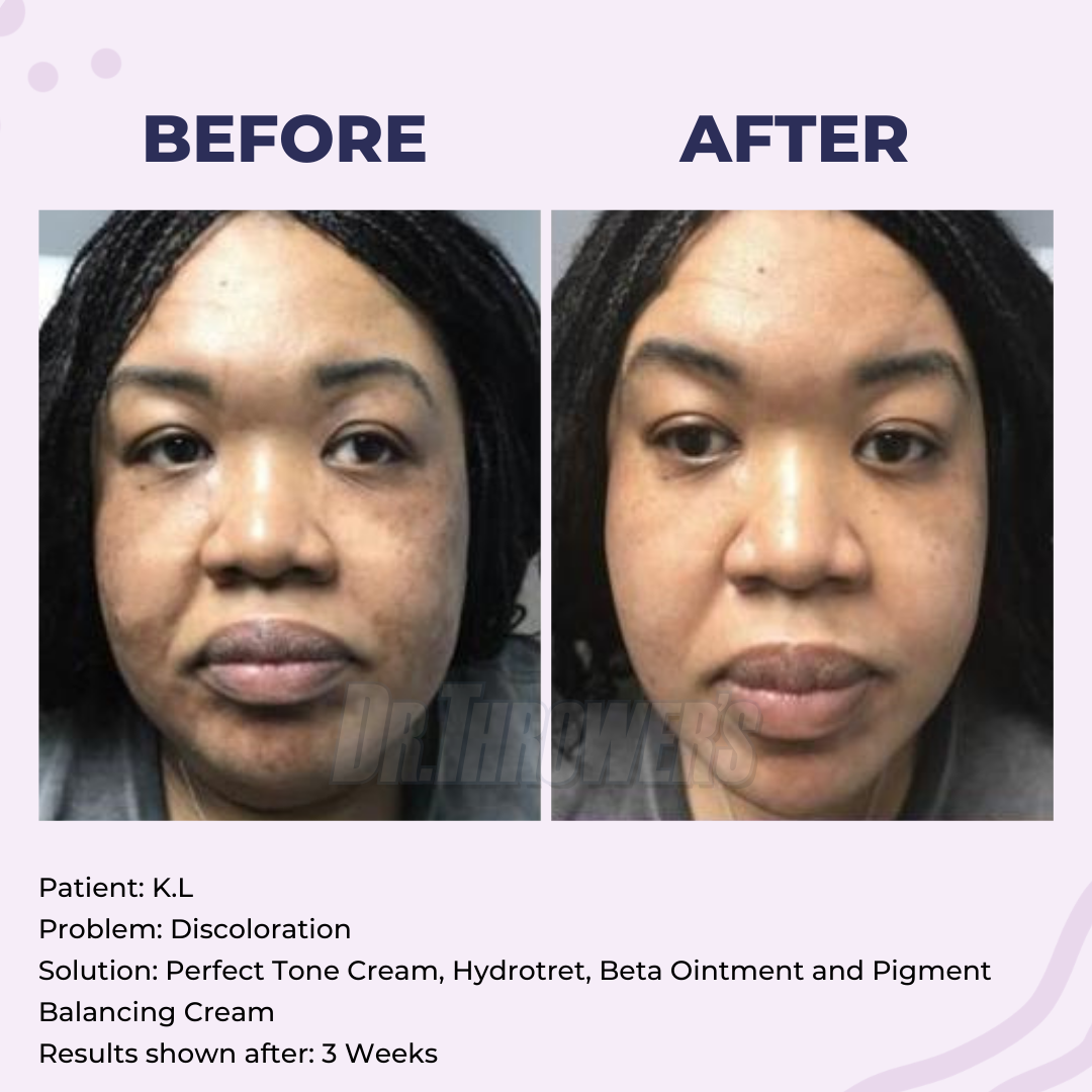 Perfect Tone Cream | Stubborn Discoloration Remover