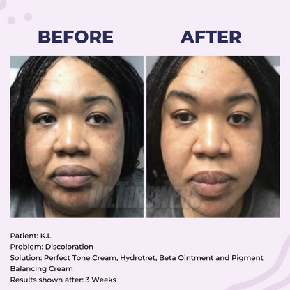 Perfect Tone Cream | Stubborn Discoloration Remover
